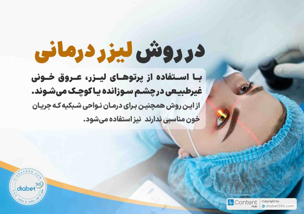 درمان رتینوپاتی دیابتی؛ آیا رتینوپاتی دیابتی درمان دارد؟ در روش لیزردرمانی، با استفاده از پرتوهای لیزر عروق خونی غیرطبیعی در چشم سوزانده یا کوچک می‌شوند. از این روش همچنین برای درمان نواحی شبکیه که جریان خون مناسبی ندارند، نیز استفاده می‌شود.