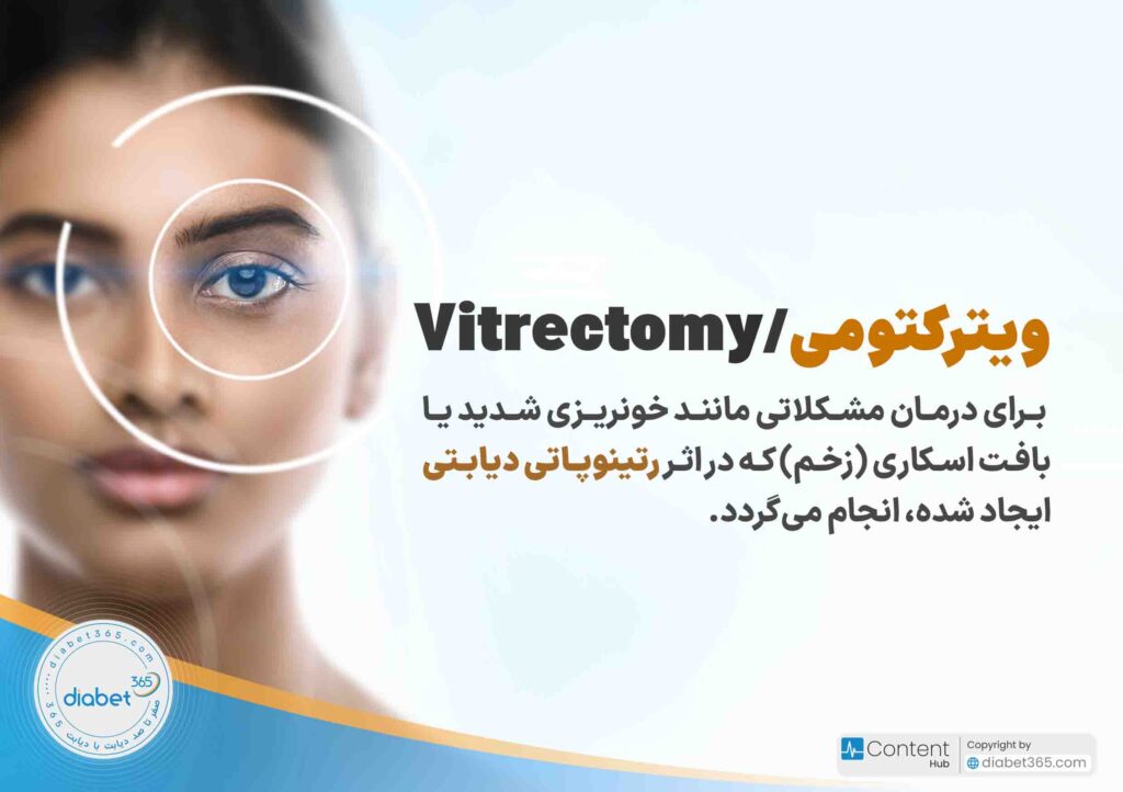 درمان رتینوپاتی دیابتی؛ آیا رتینوپاتی دیابتی درمان دارد؟ ویترکتومی برای درمان مشکلاتی مانند خونریزی شدید یا بافت اسکاری (زخم) که در اثر رتینوپاتی دیابتی ایجاد شده، انجام می‌گردد.