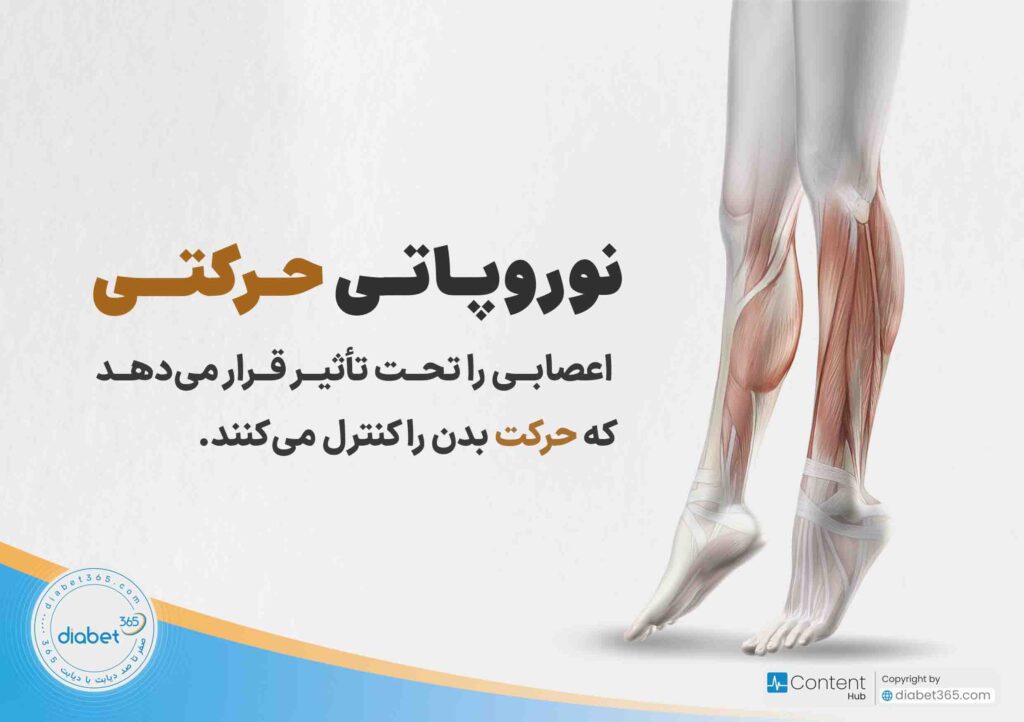 نوروپاتی دیابتی چیست و چه علائمی دارد؟ نوروپاتی حرکتی اعصابی را تحت تأثیر قرار می‌دهد که حرکت بدن را کنترل می‌کنند.