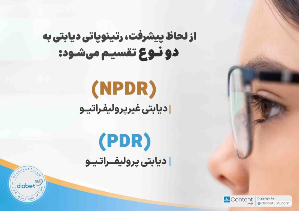 رتینوپاتی دیابتی چیست و چه علائمی دارد؟ از لحاظ پیشرفت، رتینوپاتی دیابتی به دو نوع تقسیم می‌شود: رتینوپاتی دیابتی غیرپرولیفراتیو (NPDR) رتینوپاتی دیابتی پرولیفراتیو (PDR)
