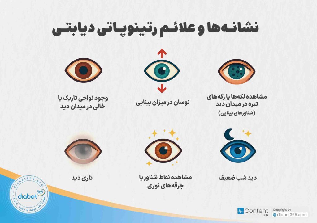رتینوپاتی دیابتی چیست و چه علائمی دارد؟ نشانه و علائم رتینوپاتی دیابتی: مشاهده لکه‌ها یا رگه‌های تیره در میدان دید (شناورهای بینایی) نوسان در میزان بینایی تاری دید دید شب ضعیف مشاهده نقاط شناور یا جرقه‌های نوری وجود نواحی تاریک یا خالی در میدان دید