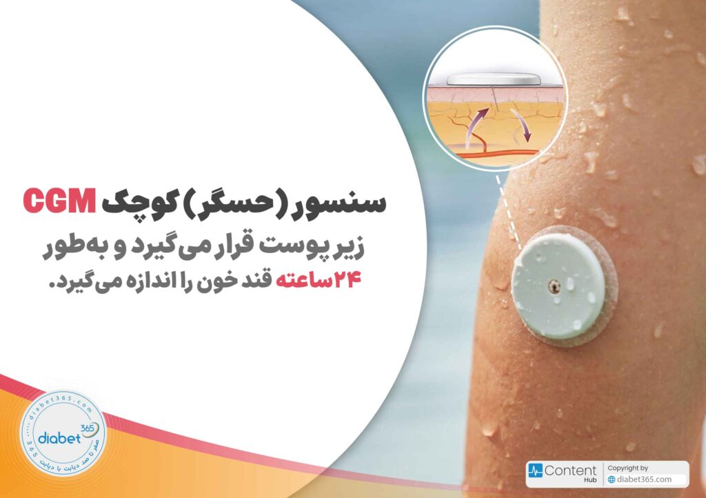 سنسور (حسگر) کوچک CGM زیر پوست قرار میگیرد و بهطور ۲۴ساعته قند خون را اندازه میگیرد.