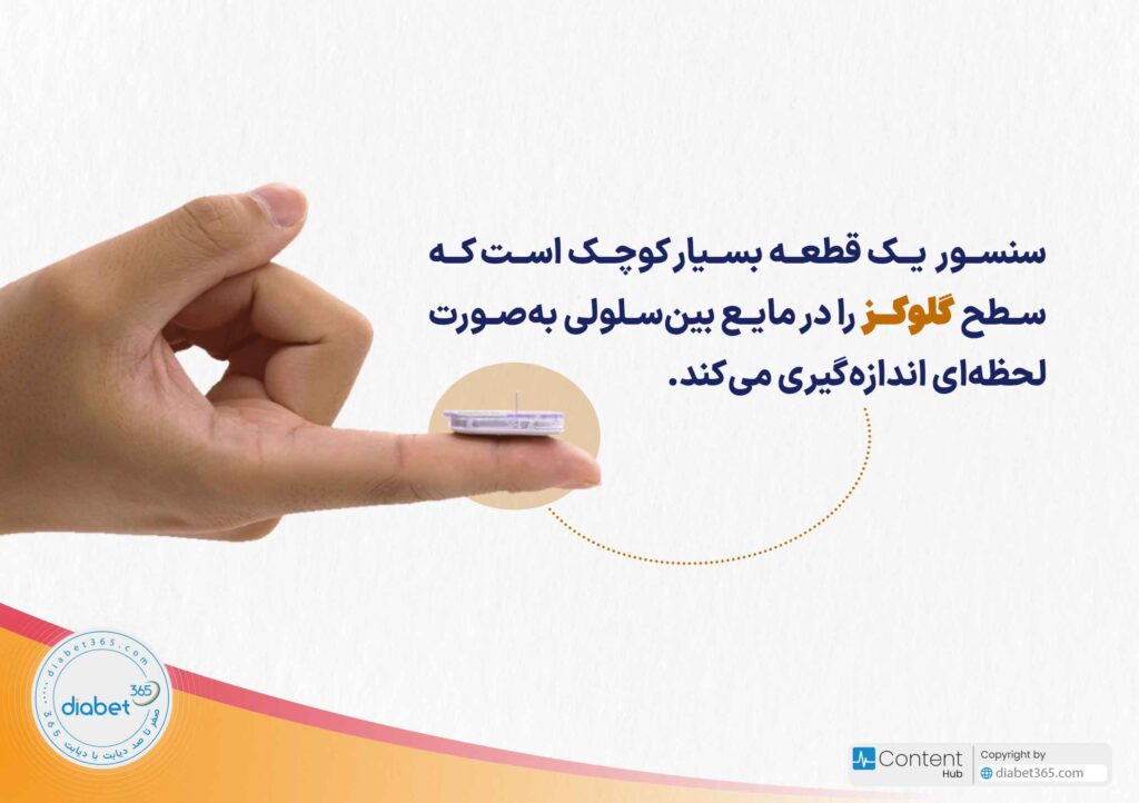 سنسور یک قطعه بسیار کوچک است که سطح گلوکز را در مایع بینسلولی بهصورت لحظهای اندازهگیری میکند.
