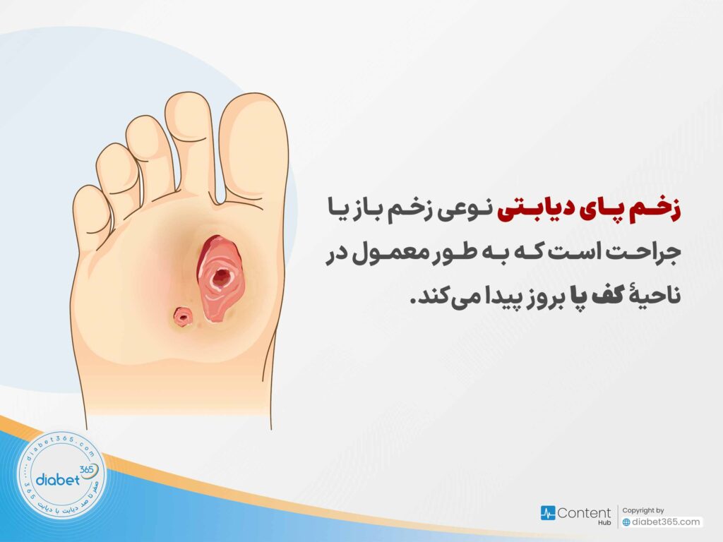 چگونه از زخم پای دیابتی جلوگیری کنیم؟: زخم پای دیابتی نوعی زخم باز یا جراحت است که به طور معمول در ناحیۀ کف پا بروز پیدا میکند.