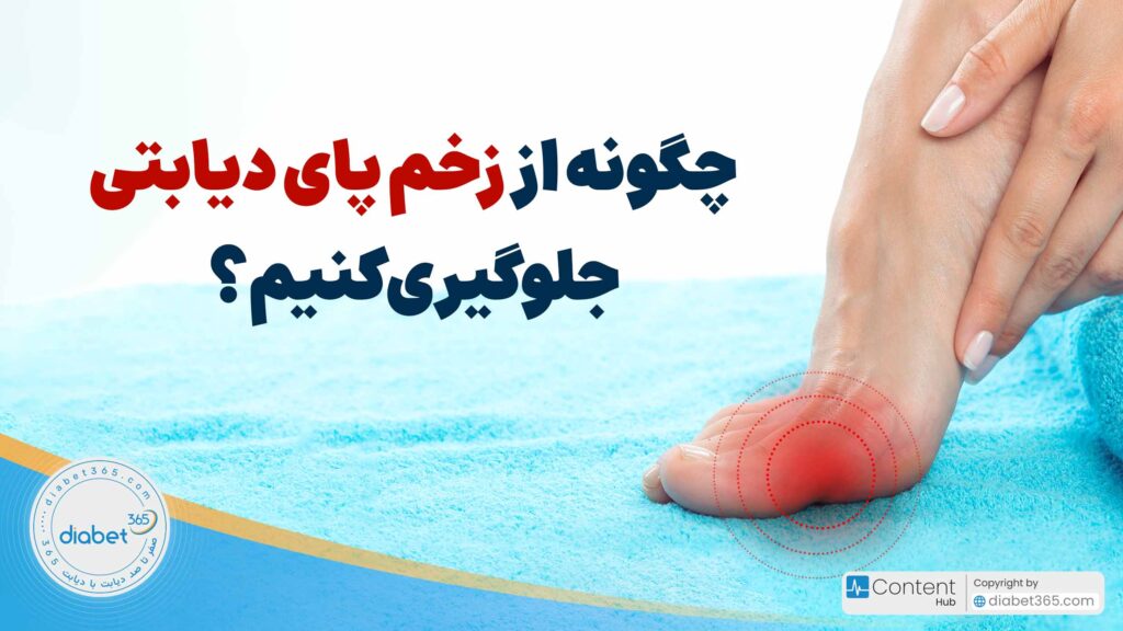 چگونه از زخم پای دیابتی جلوگیری کنیم؟
