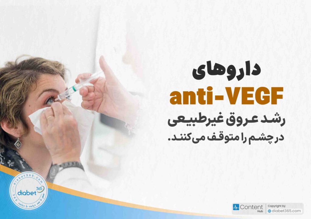 درمان رتینوپاتی دیابتی؛ آیا رتینوپاتی دیابتی درمان دارد؟ داروهای anti-VEGF رشد عروق غیرطبیعی در چشم را متوقف میکنند.