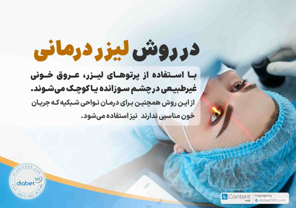 درمان رتینوپاتی دیابتی؛ آیا رتینوپاتی دیابتی درمان دارد؟ در روش لیزردرمانی، با استفاده از پرتوهای لیزر عروق خونی غیرطبیعی در چشم سوزانده یا کوچک میشوند. از این روش همچنین برای درمان نواحی شبکیه که جریان خون مناسبی ندارند، نیز استفاده میشود.