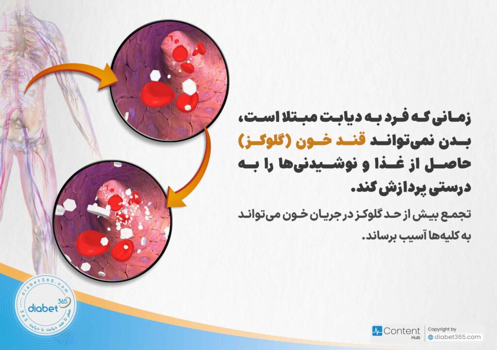نفروپاتی دیابتی چیست و چه علائمی دارد؟ زمانی که فرد به دیابت مبتلا است، بدن نمیتواند قند خون (گلوکز) حاصل از غذا و نوشیدنیها را به درستی پردازش کند. تجمع بیش از حد گلوکز در جریان خون میتواند به کلیهها آسیب برساند.