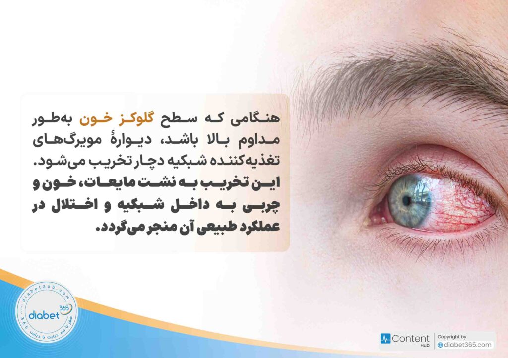 رتینوپاتی دیابتی چیست و چه علائمی دارد؟ هنگامی که سطح گلوکز خون بهطور مداوم بالا باشد، دیوارۀ مویرگهای تغذیهکننده شبکیه دچار تخریب میشود. این تخریب به نشت مایعات، خون و چربی به داخل شبکیه و اختلال در عملکرد طبیعی آن منجر میگردد.