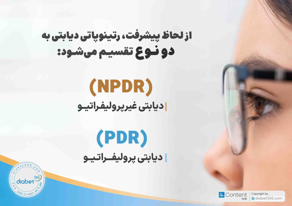 رتینوپاتی دیابتی چیست و چه علائمی دارد؟ از لحاظ پیشرفت، رتینوپاتی دیابتی به دو نوع تقسیم میشود: رتینوپاتی دیابتی غیرپرولیفراتیو (NPDR) رتینوپاتی دیابتی پرولیفراتیو (PDR)