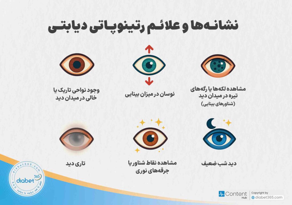 رتینوپاتی دیابتی چیست و چه علائمی دارد؟ نشانه و علائم رتینوپاتی دیابتی: مشاهده لکهها یا رگههای تیره در میدان دید (شناورهای بینایی) نوسان در میزان بینایی تاری دید دید شب ضعیف مشاهده نقاط شناور یا جرقههای نوری وجود نواحی تاریک یا خالی در میدان دید