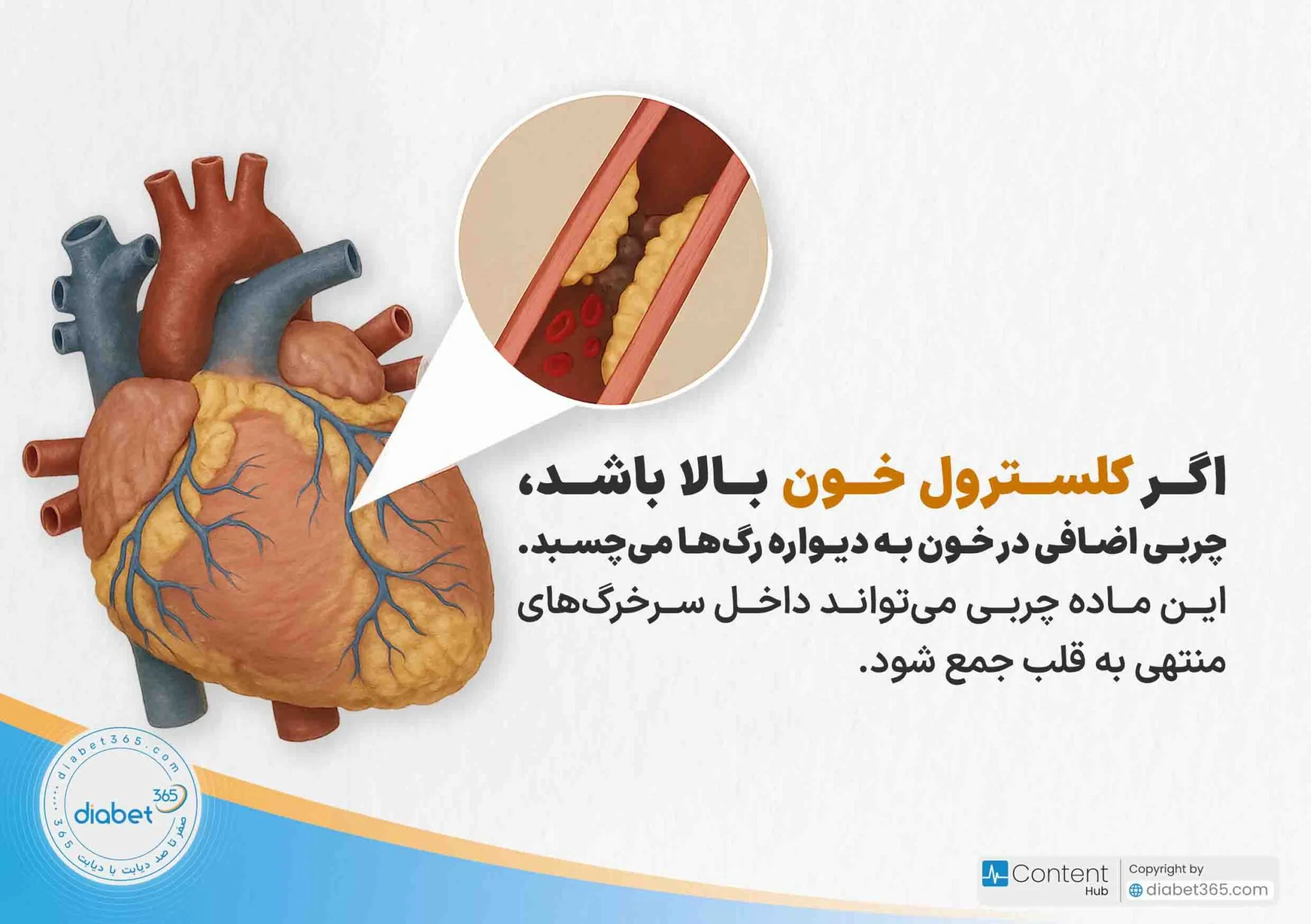 حمله قلبی دیابتی چیست و چه علائمی دارد؟