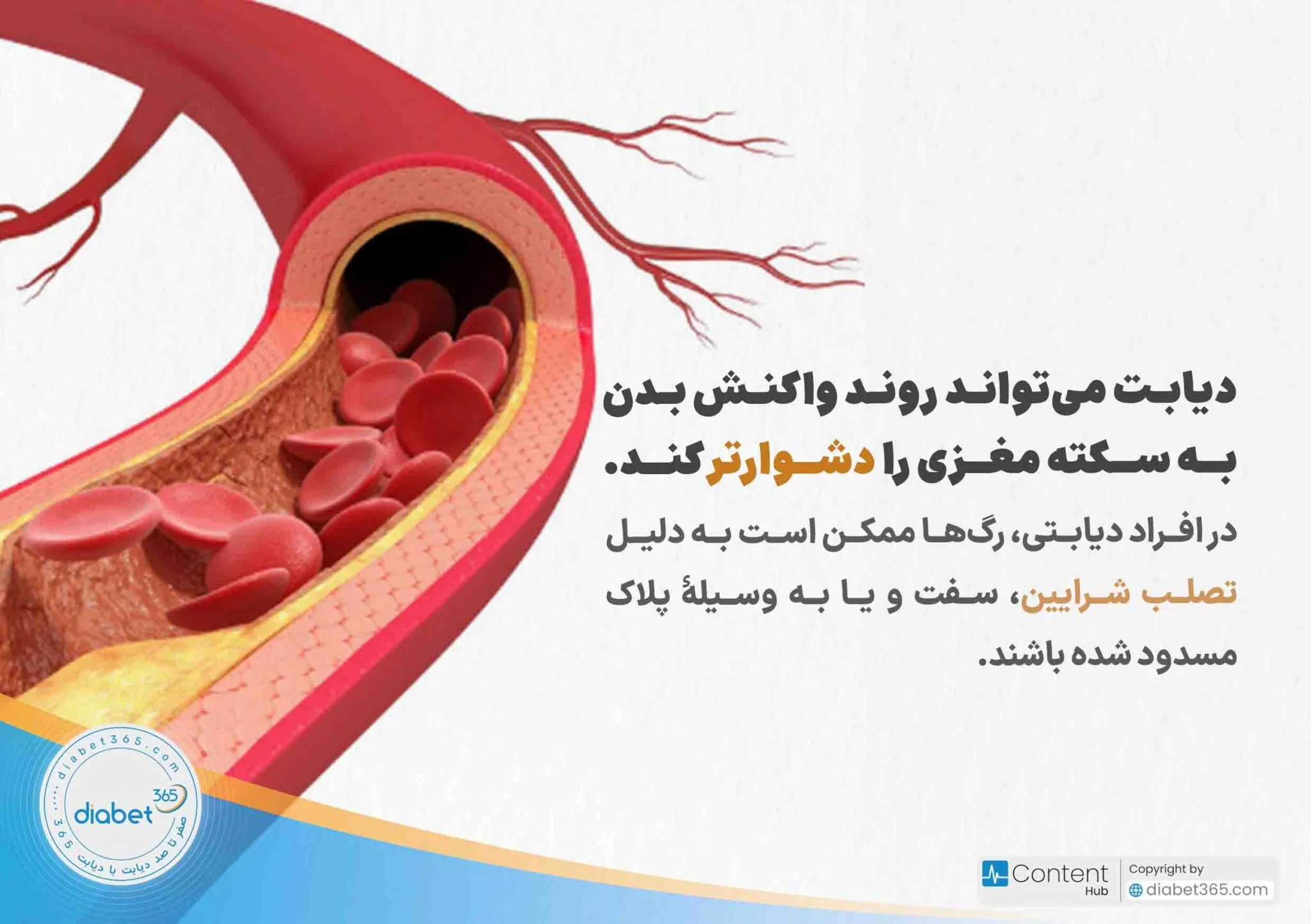 دیابت و سکته مغزی؛ آیا دیابت خطر سکته مغزی را افزایش می‌دهد؟