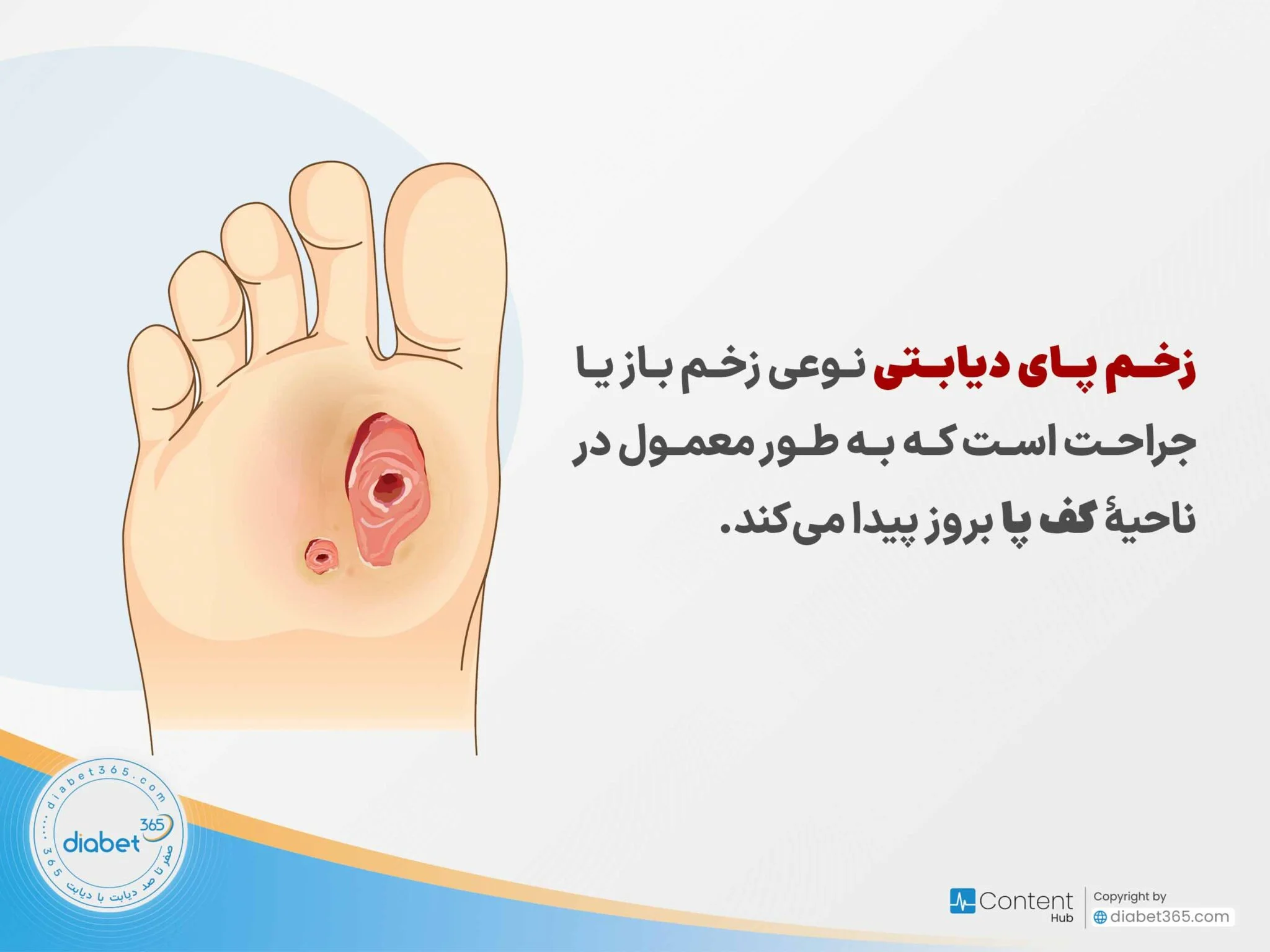 چگونه از زخم پای دیابتی جلوگیری کنیم؟
