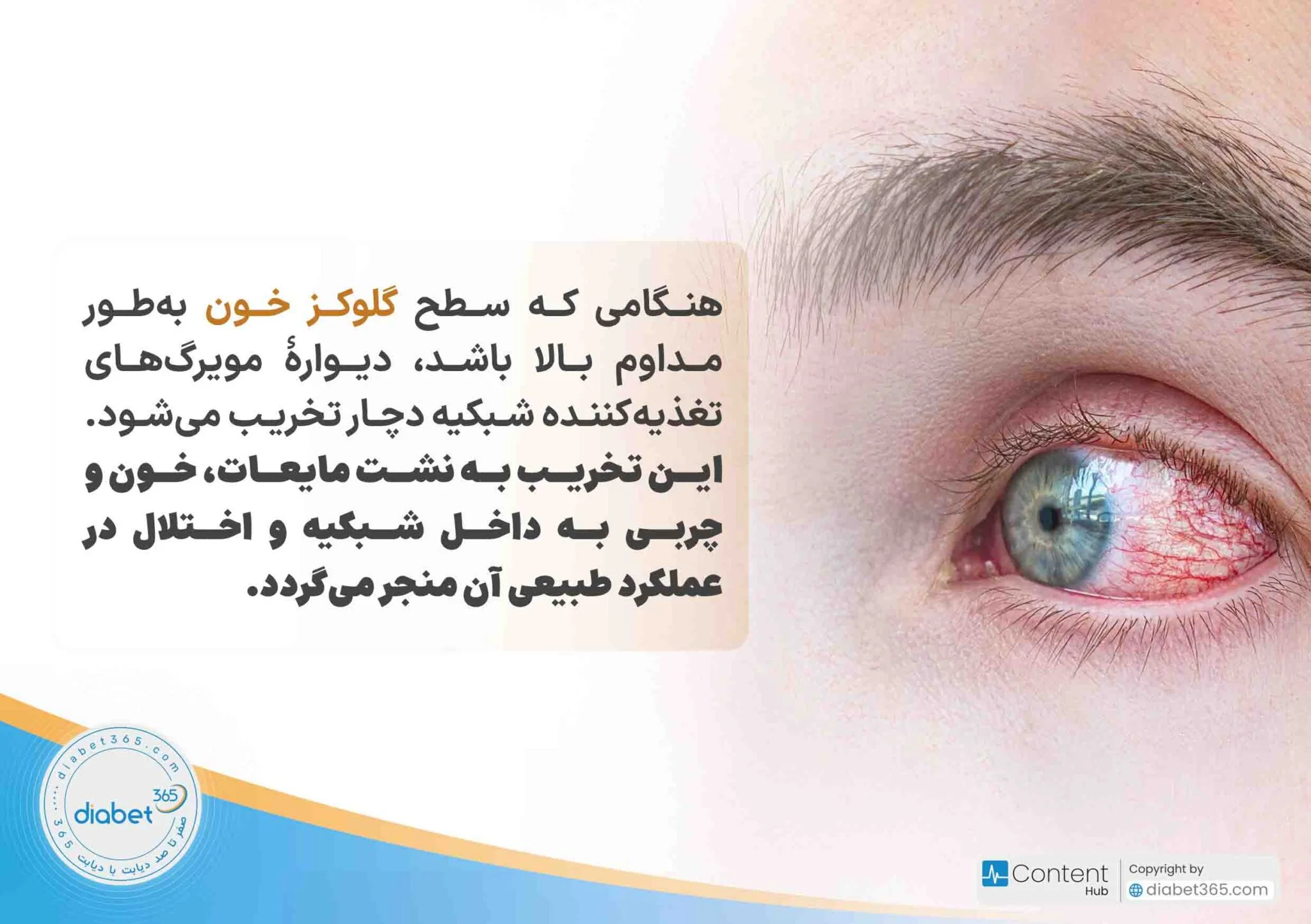 رتینوپاتی دیابتی چیست و چه علائمی دارد؟